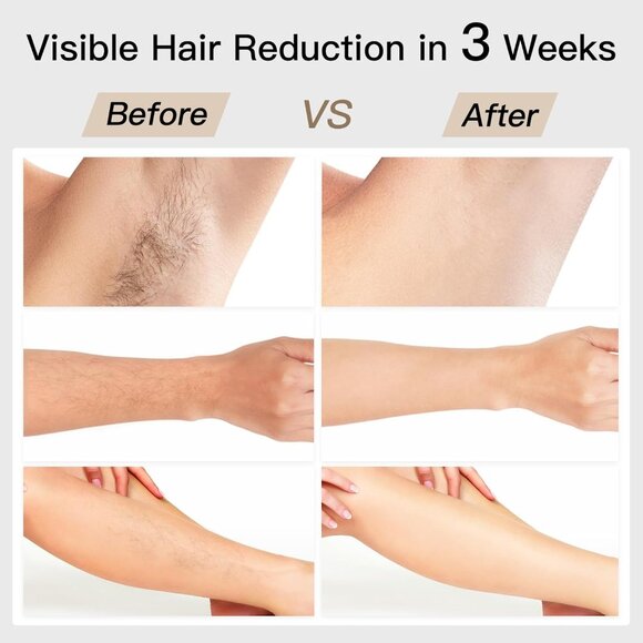 Laser Hair Removal, BoSidin IPL Hair Removal with Painless Ice-Cooling - Picture 6 of 9
